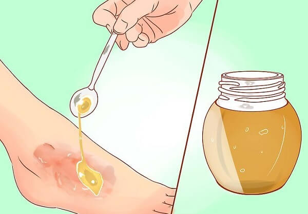 trị bỏng bằng mật ong